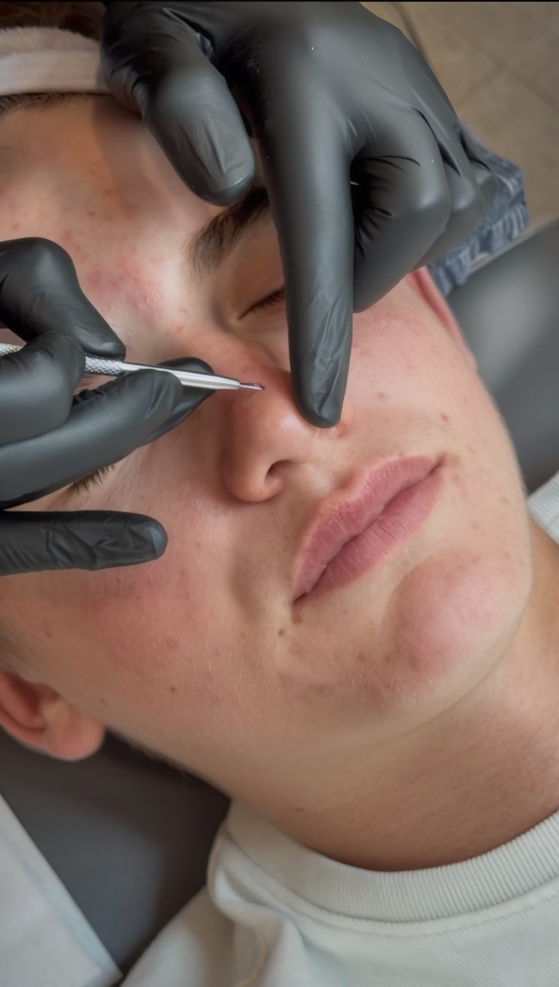 Acne Bootcamp Treatment
