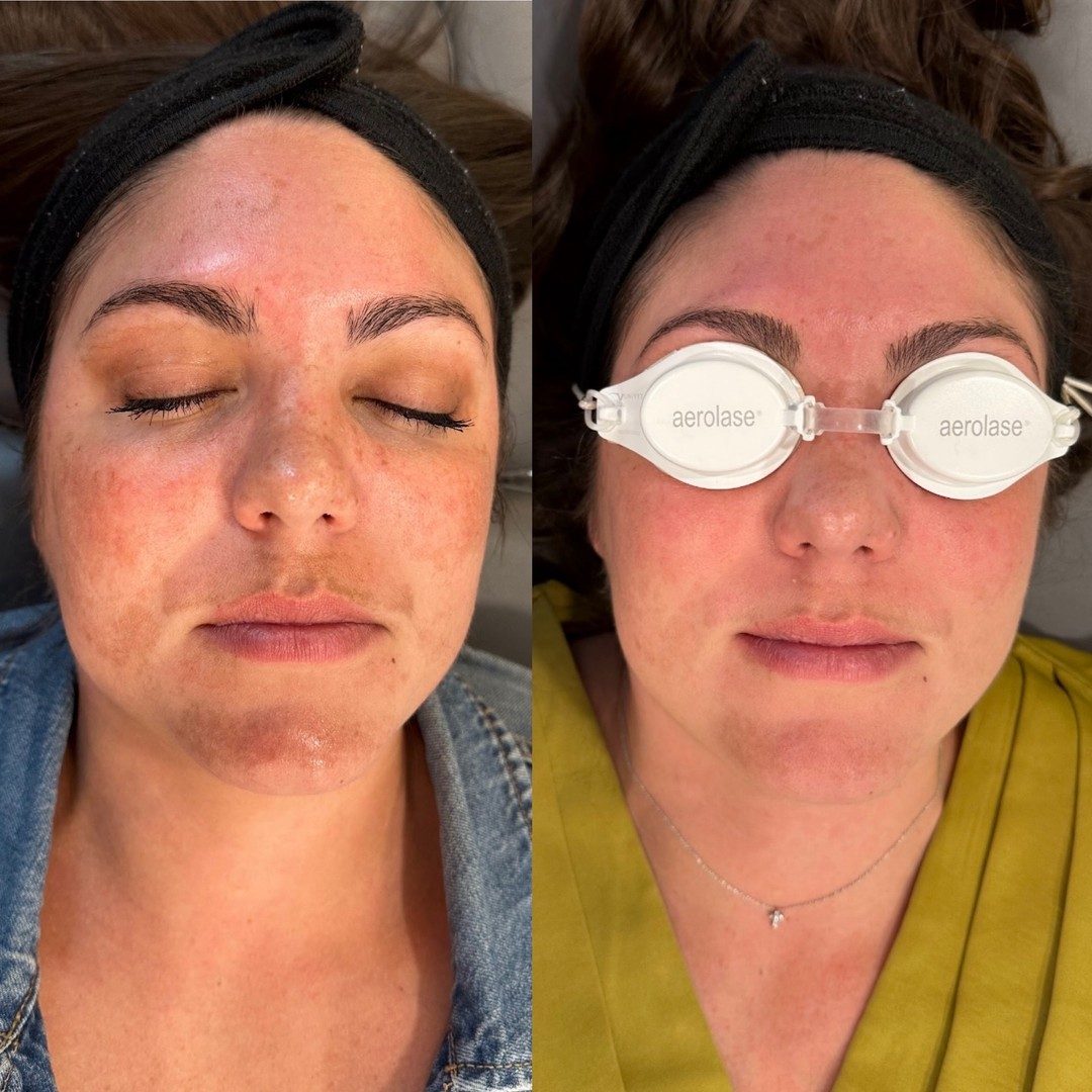 Aerolase NeoSkin before and after