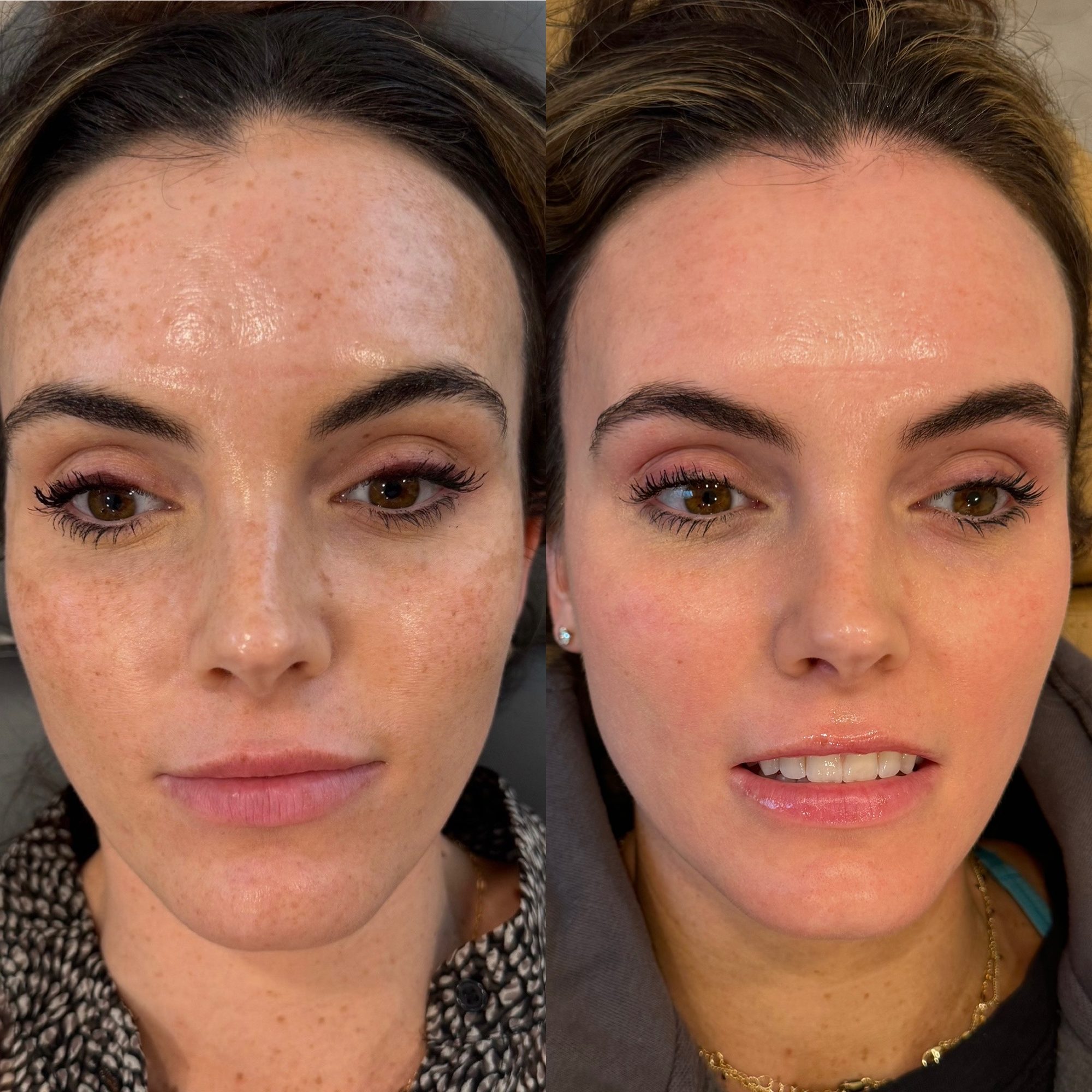 LaseMD · pigmentation before and after