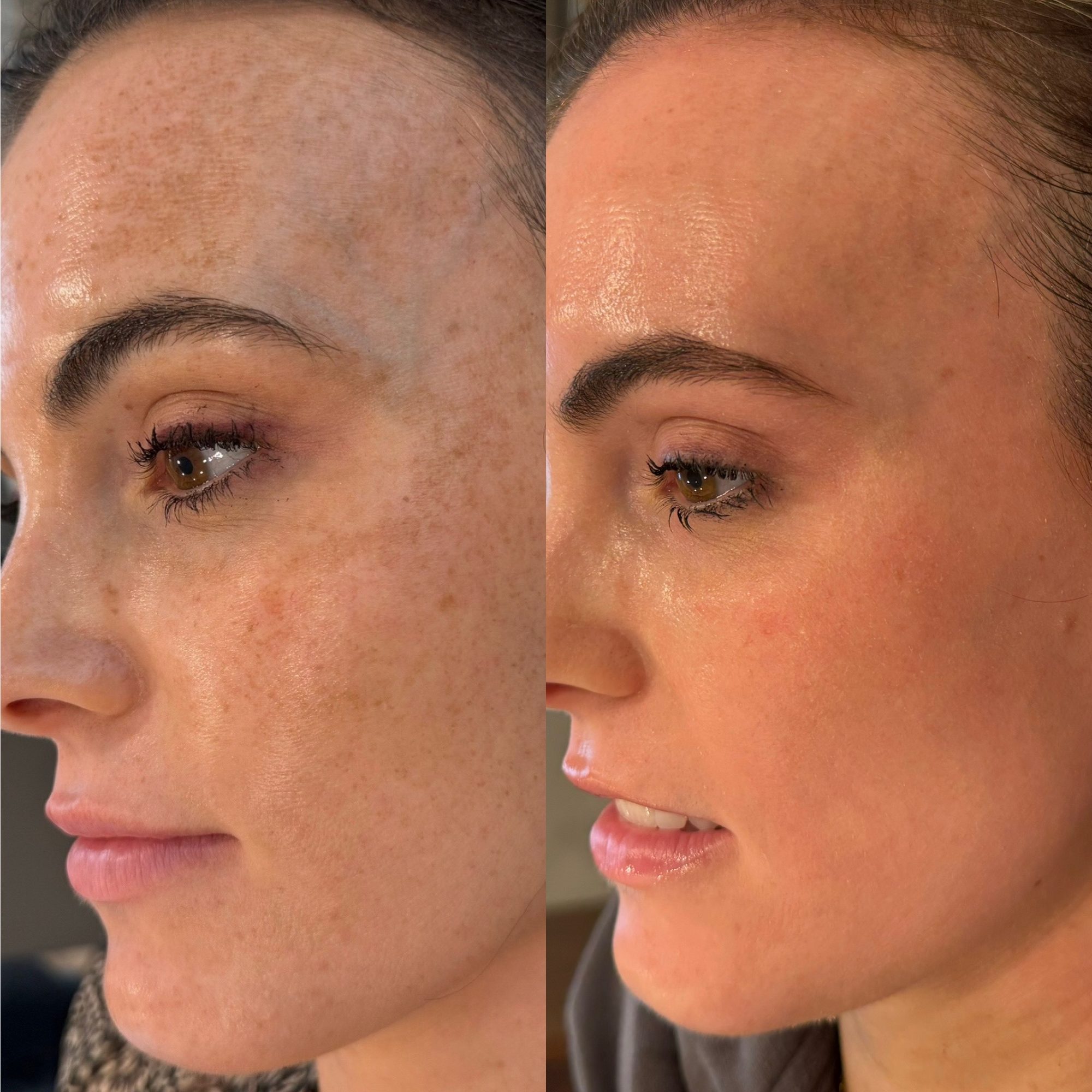 LaseMD · tone & texture before and after