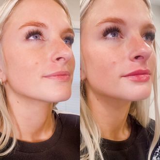 Lip filler before and after