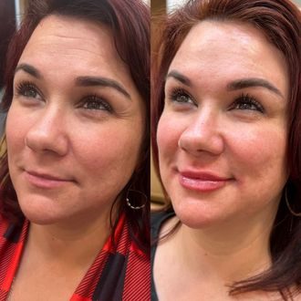 Lip filler before and after
