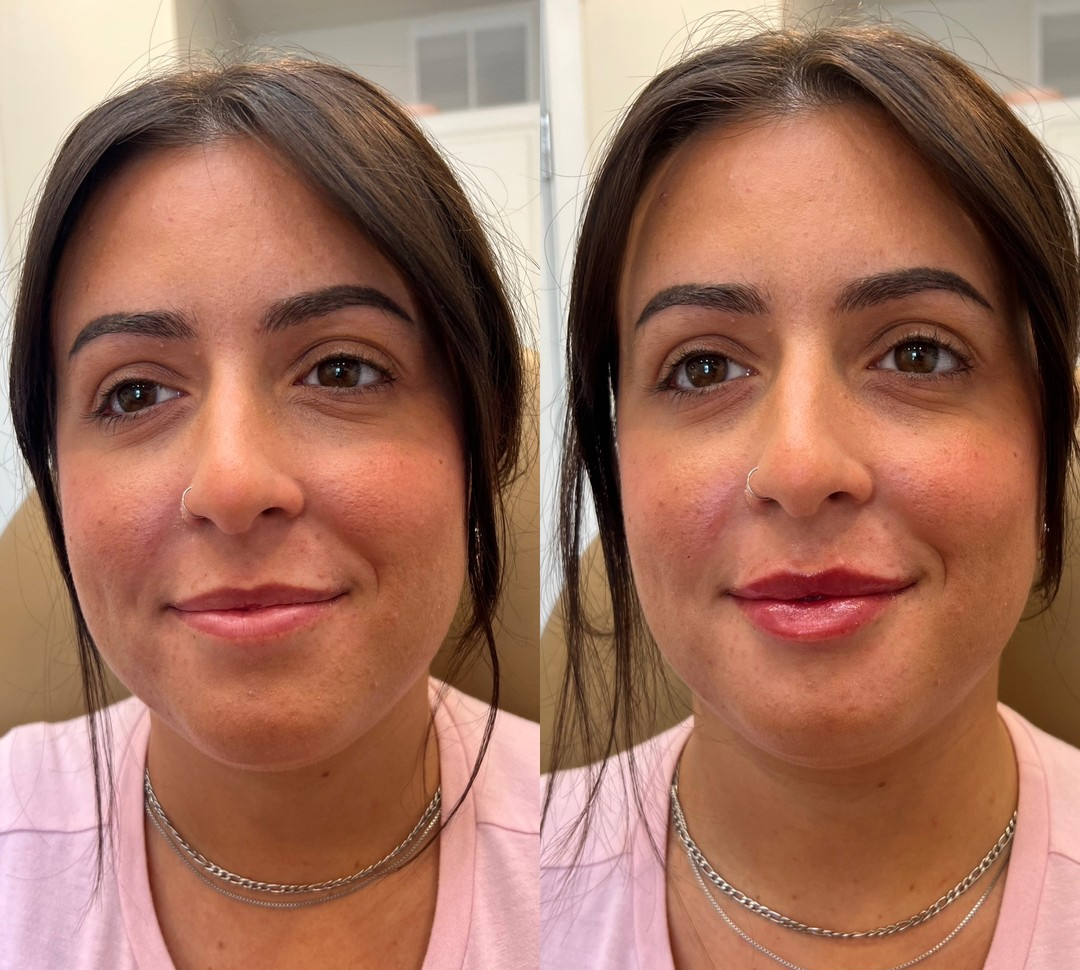 Lip filler · first syringe before and after