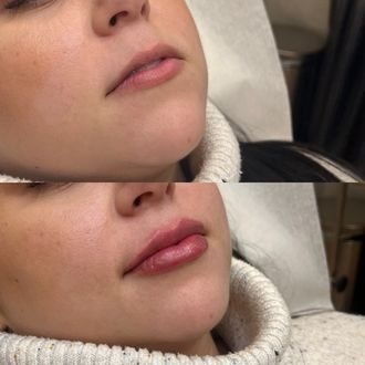 Lip filler before and after