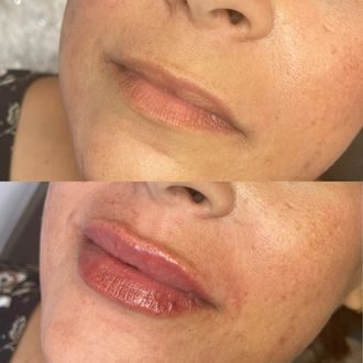 Lip filler before and after