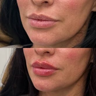 Lip filler before and after