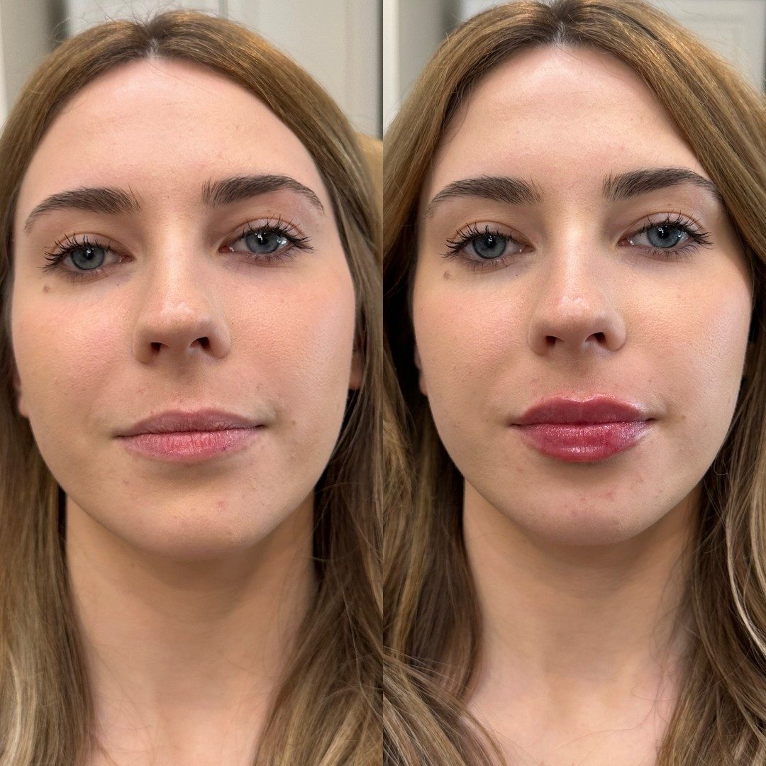 Lip filler · subtle volume before and after