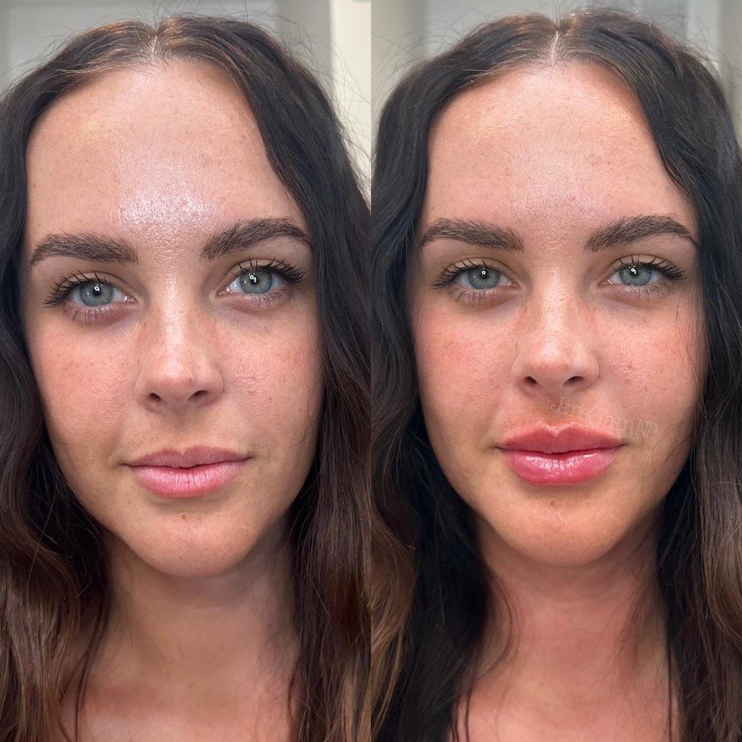 Lip filler before and after