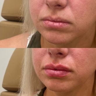 Lip hydration before and after