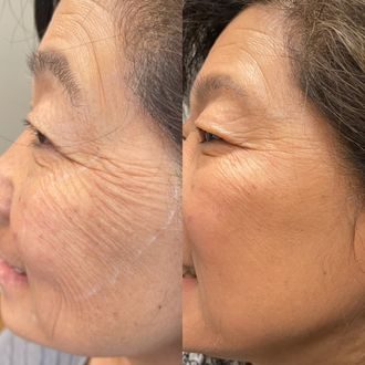 Microtox · crepey skin before and after