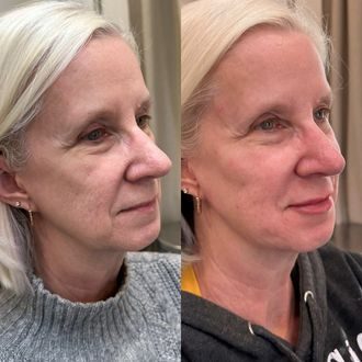 Sculptra before and after