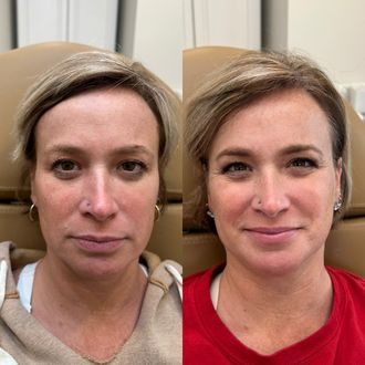 Sculptra before and after