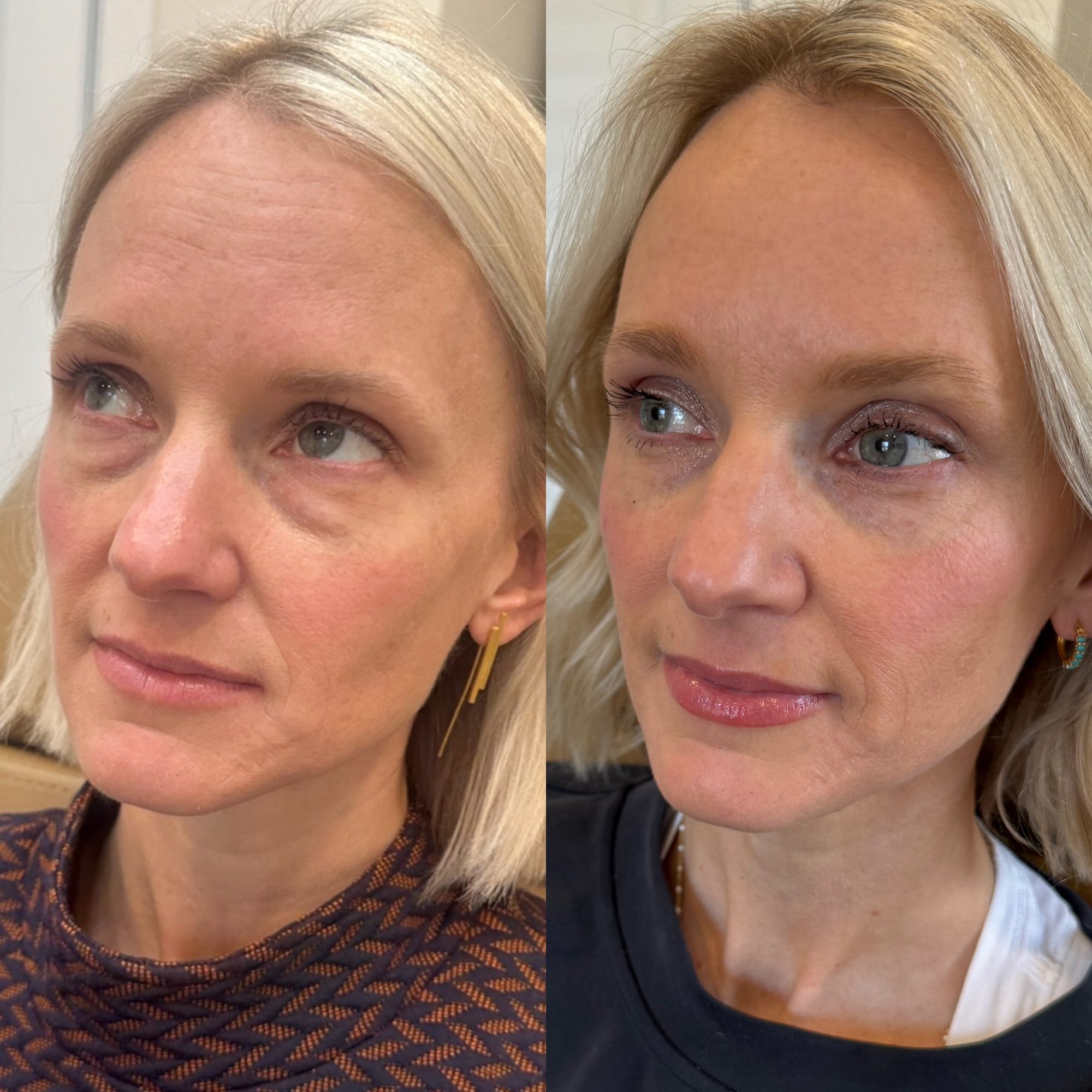 Sculptra · midface lift before and after