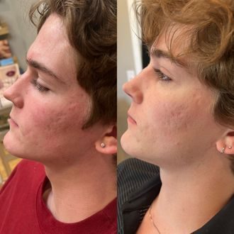 Acne scarring before and after