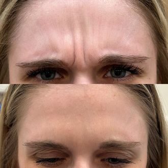 Glabella before and after