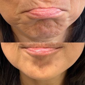 Chin & perioral before and after