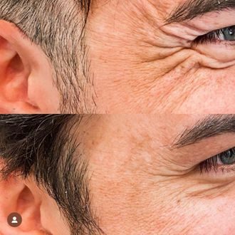 Crow's feet before and after
