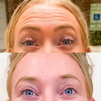 Forehead lines before and after