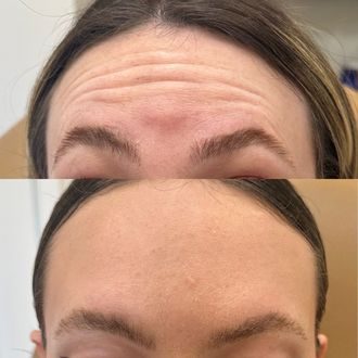 Forehead lines before and after