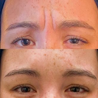 Glabella (11s) before and after