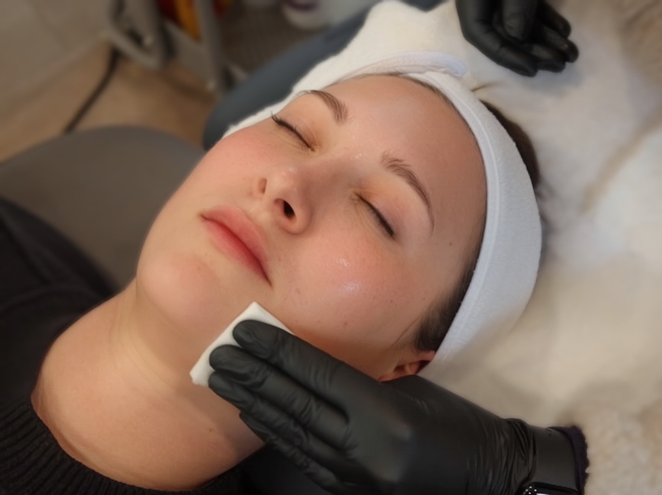 Chemical Peels